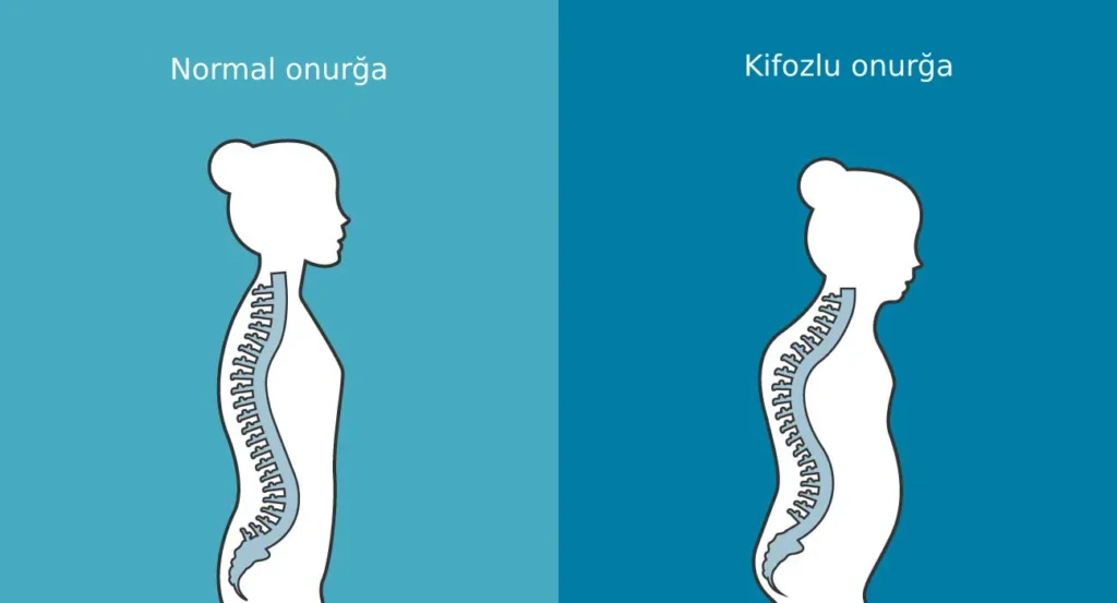kifoz nədir